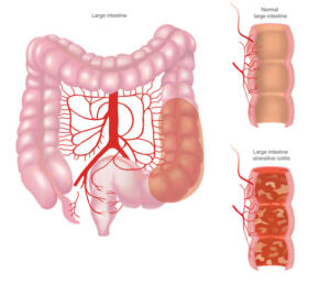 Picture of ulcerative colitis caused by abnormal immune system usually affect only the inner layer of the bowel wall.