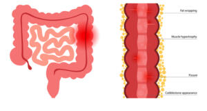 Picture of Crohns disease concept. Intestine anatomical infographic. Inflammatory bowel disease. Inflammation of the digestive tract, abdominal pain, colon problem in human body. Medical flat vector illustration