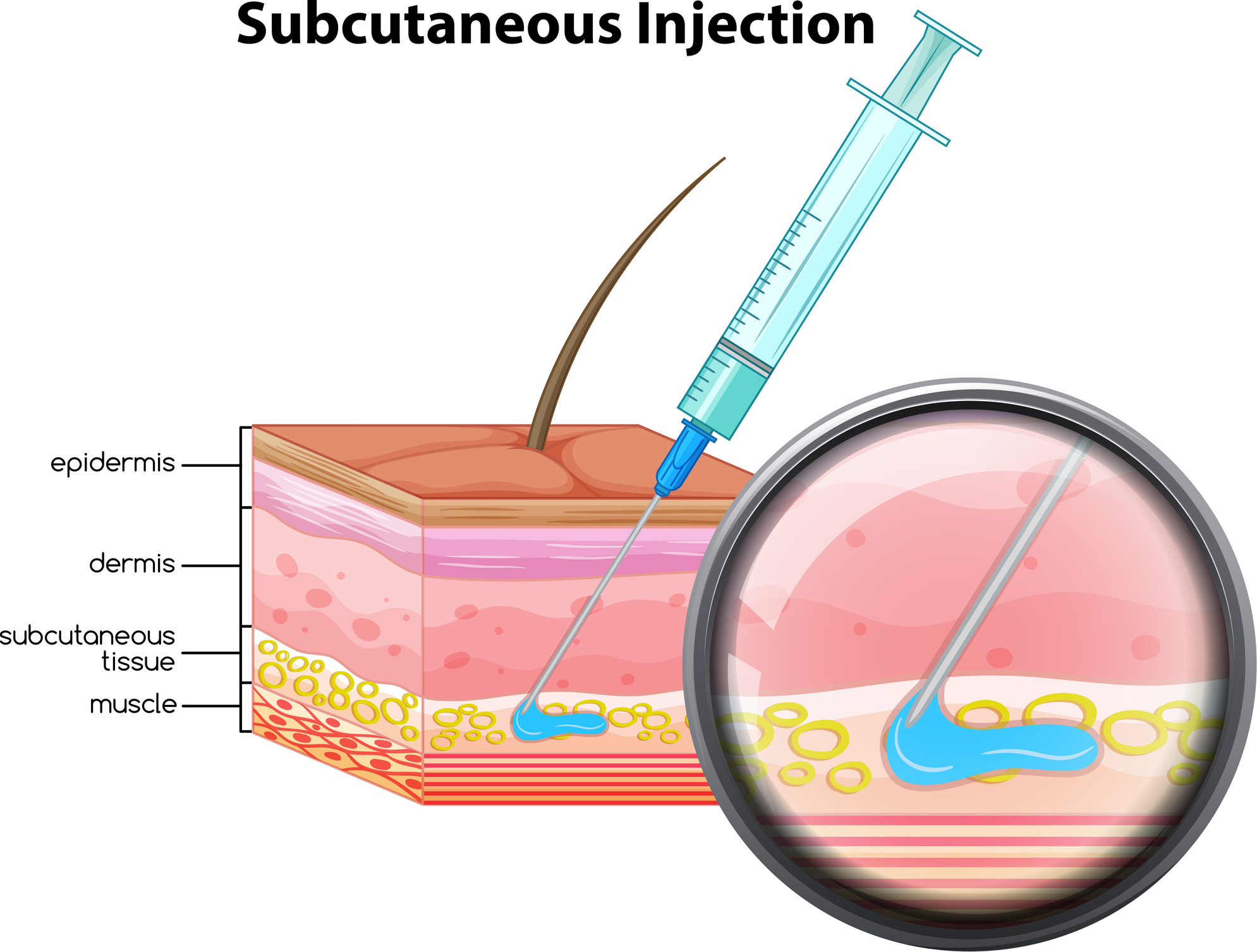 Scig IVIG and SCIG: A Comprehensive Guide for Patients